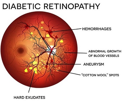 Diabetic Retinopathy, eye diseases | Global Eye Hospital