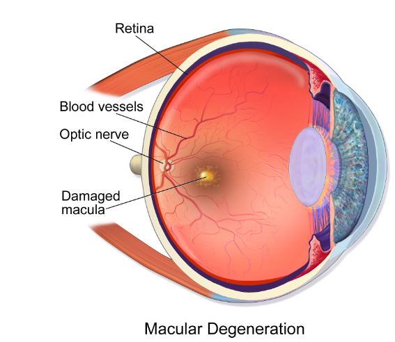 Macular degeneration