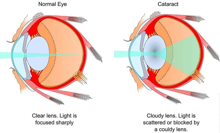 comparison between a healthy eye and a cataract affected eye