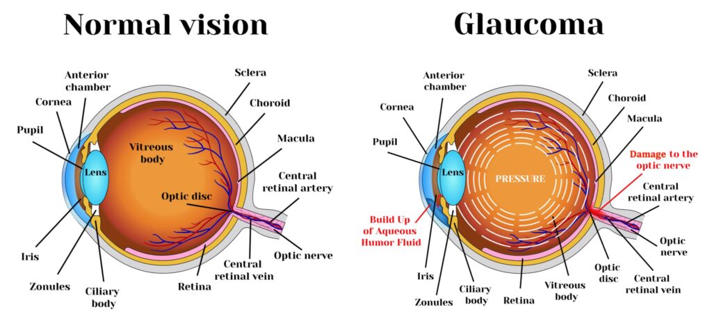Comparison between a healthy eye and an eye affected with glaucoma, eye health | Global Eye Hospital Hyderabad