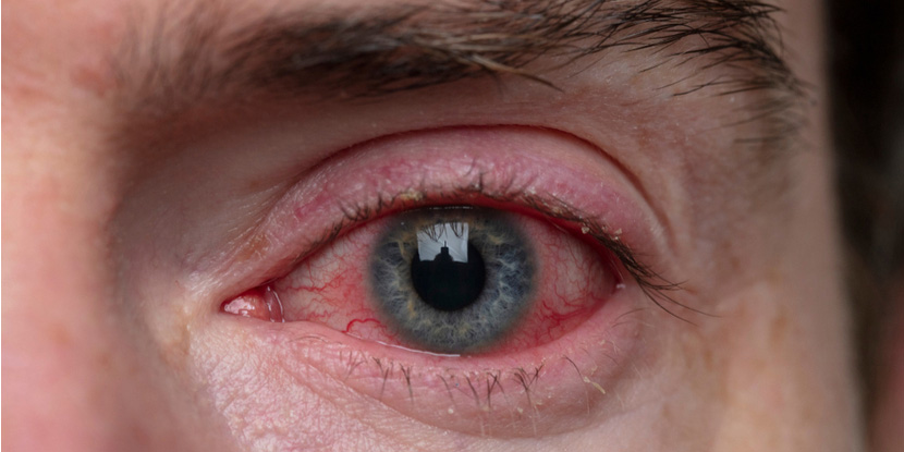Red Eye, Corneal Sunburn | Global Eye Hospital Hyderabad