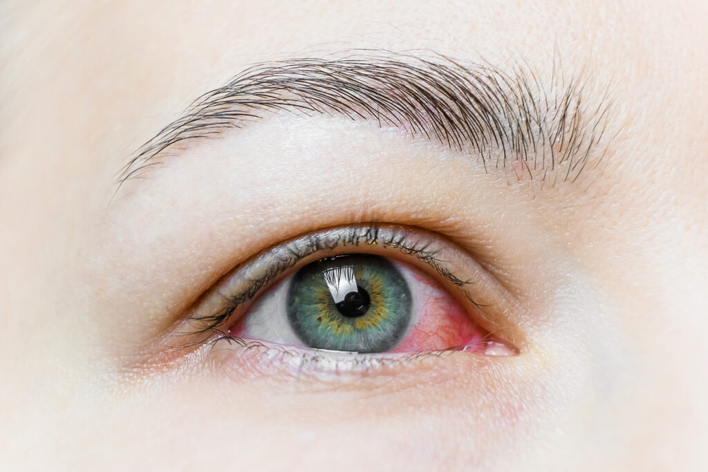 Conjunctivitis - Understanding Photophobia, Global Eye Hospital