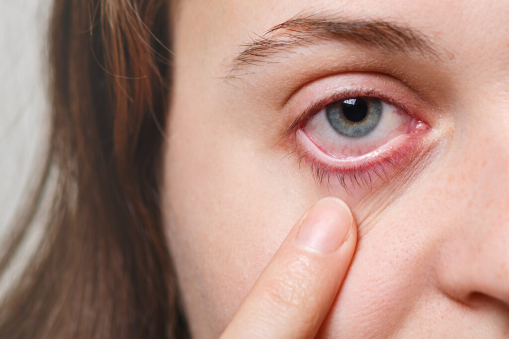 Dry eyes - Understanding Photophobia, Global Eye Hospital