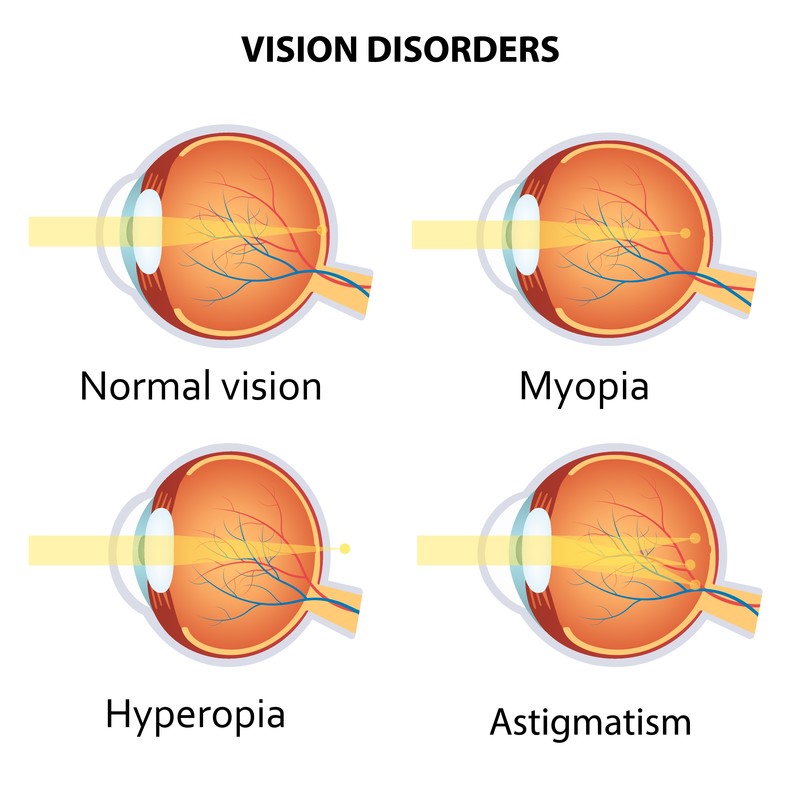 Vision disorders - A brief about contact lenses - The Global Eye Hospital