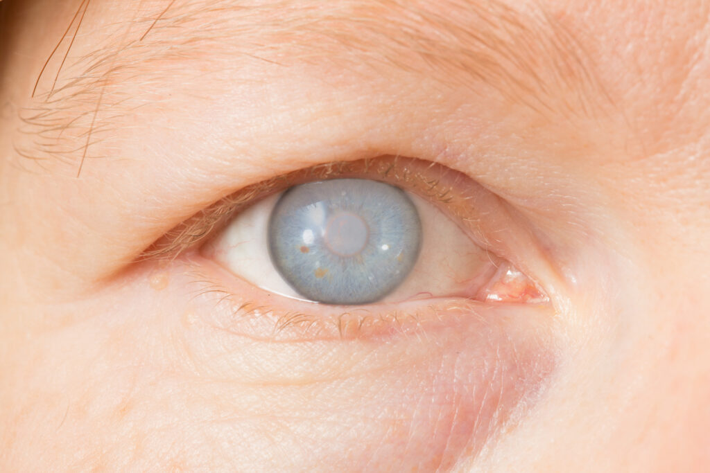 Eye with cataract - A brief about different types of cataracts - Global eye hospital