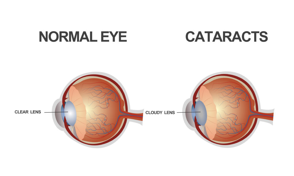 Normal eye Vs Cataract - A brief about different types of cataracts - Global eye hospital