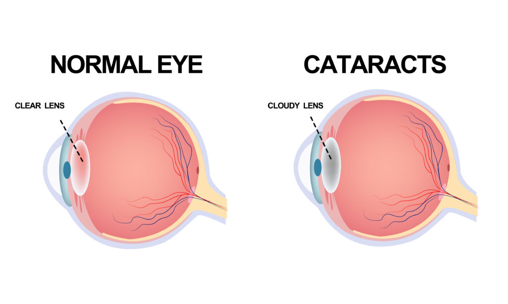 cataracts - What are the types of cataract surgeries - Global eye hospital