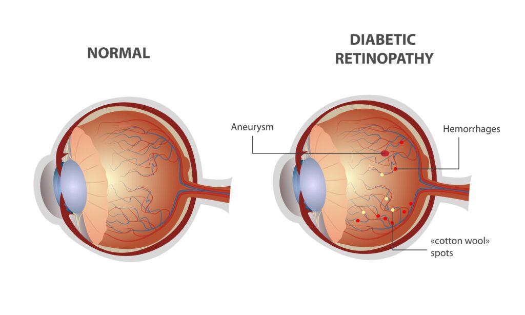 Comparison between normal eye and eye affected due to diabetic retinopathy - What are the types of diabetic retinopathy - Global Eye Hospital