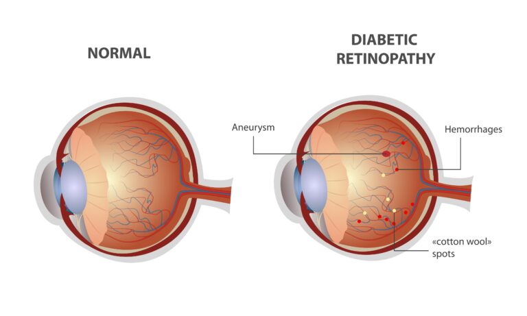 What Are The Types Of Diabetic Retinopathy Global Eye Hospital