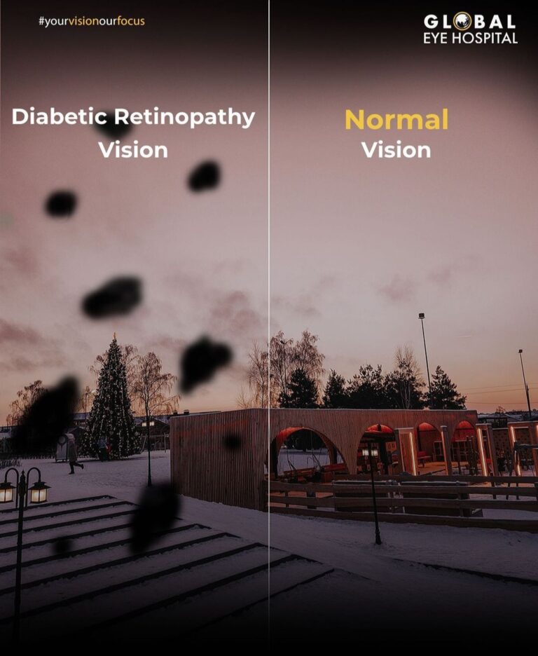 What are the types of diabetic retinopathy? - Global Eye Hospital