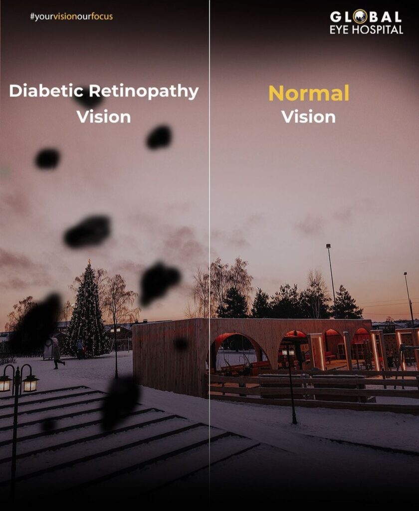 Comparision of vision of diabetic retinopathy effected eye Vs Normal eye - What are the types of diabetic retinopathy - Global Eye Hospital