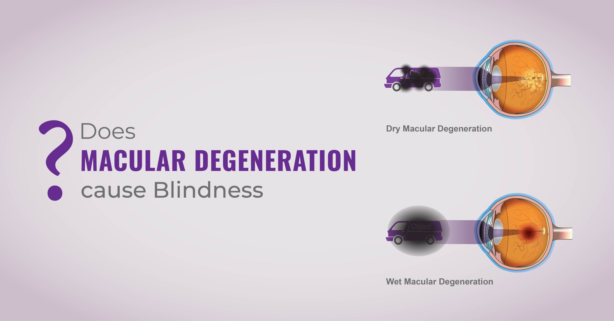 Does macular degeneration cause blindness? - Global Eye Hospital