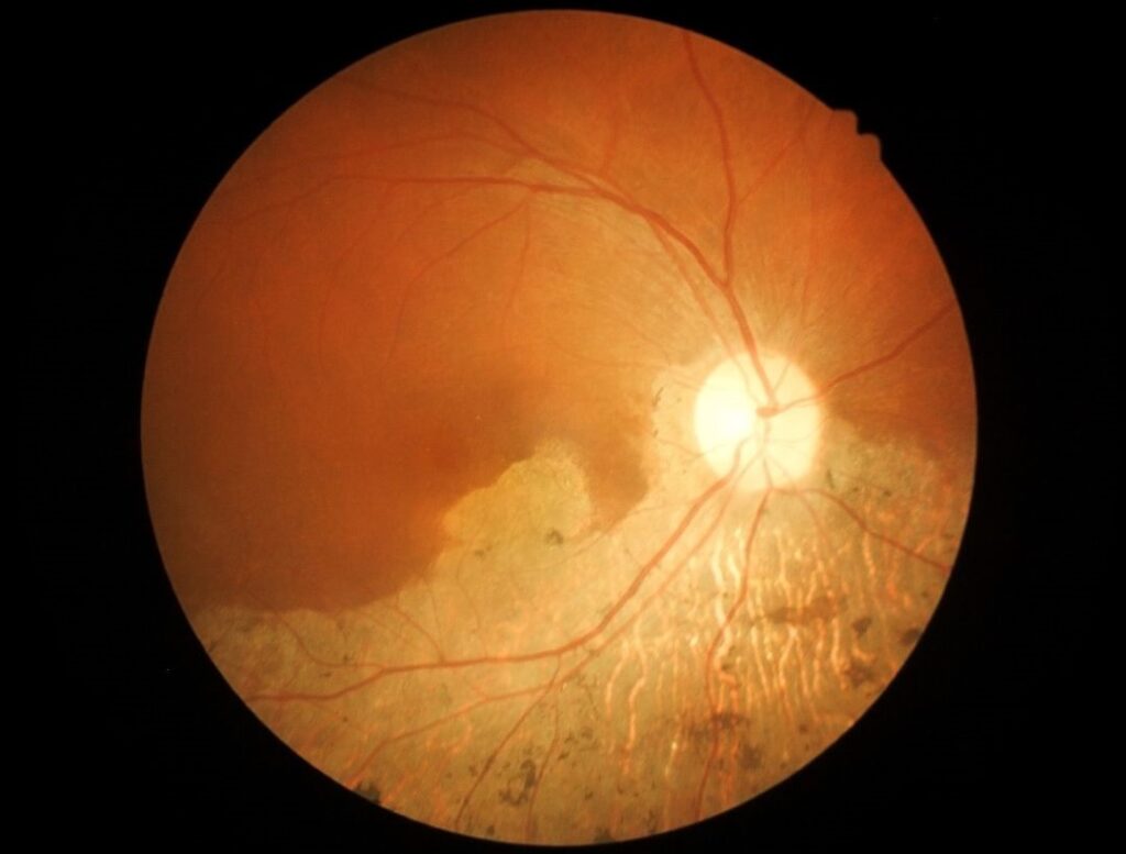 Effect of age-related macular degeneration - Does macular degeneration cause blindness - Global Eye Hospital