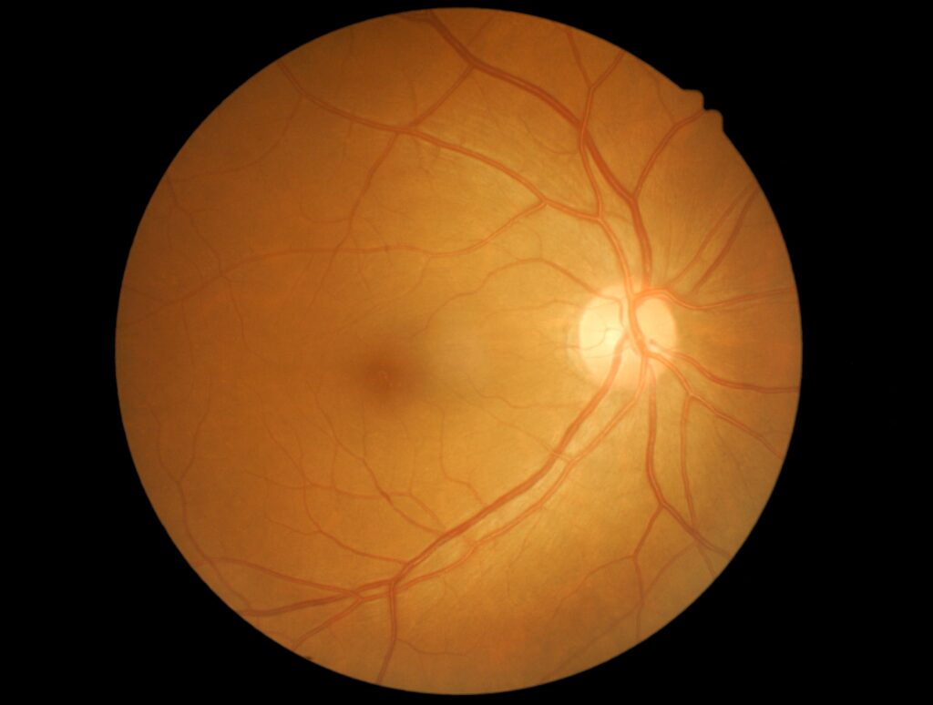 Effect of diabetic retinopathy  - What are the types of diabetic retinopathy - Global Eye Hospital