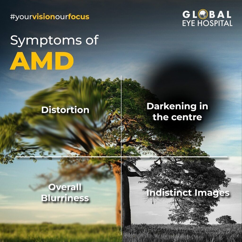 Symptoms of age-related macular degeneration - Does macular degeneration cause blindness - Global Eye Hospital