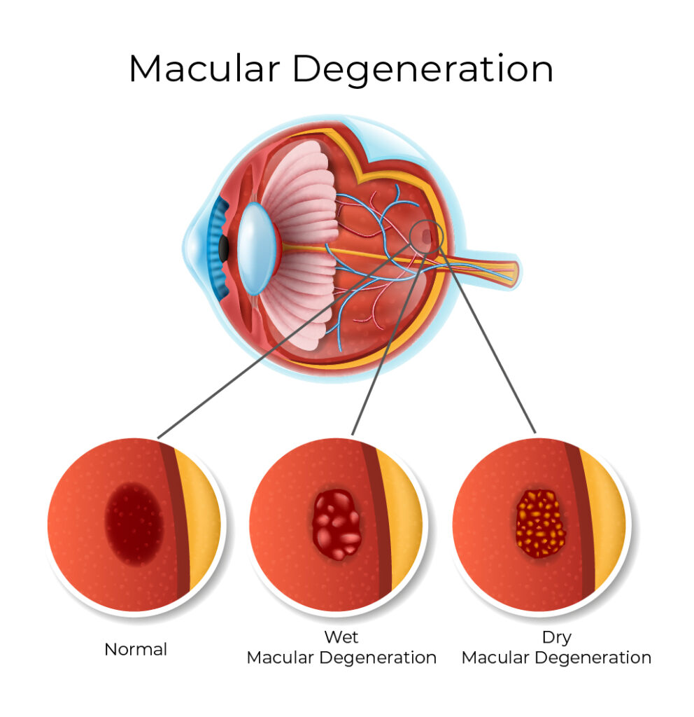Types of macular degeneration - Does macular degeneration cause blindness - Global Eye Hospital