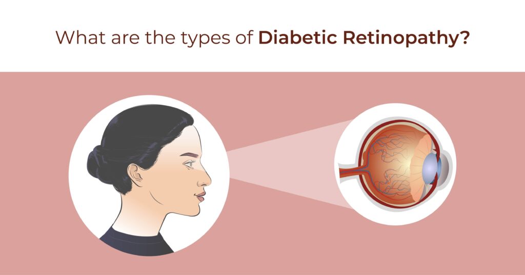 What are the types of diabetic retinopathy - Global Eye Hospital