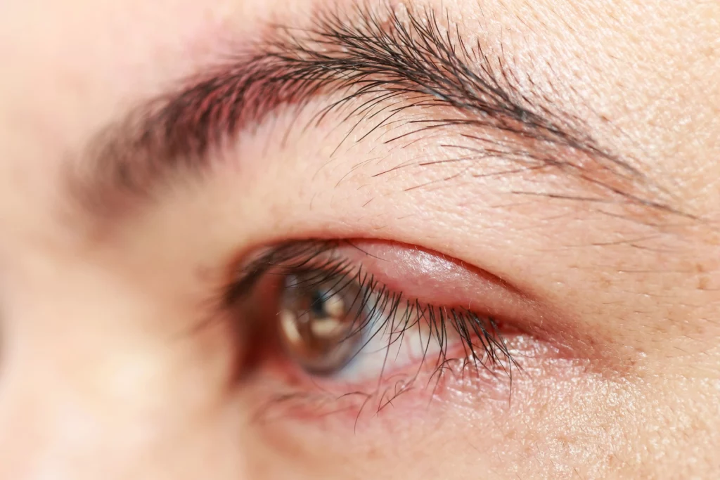 What's A Chalazion, And Why Should You Consider Getting It Excised - Chalazion - Global Eye Hospital