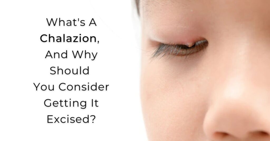 What's A Chalazion, And Why Should You Consider Getting It Excised - Global Eye Hospital