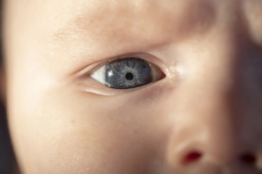 Cataracts in Children Causes, Symptoms, and Treatment -Eye of a Child- Global Eye Hospital 