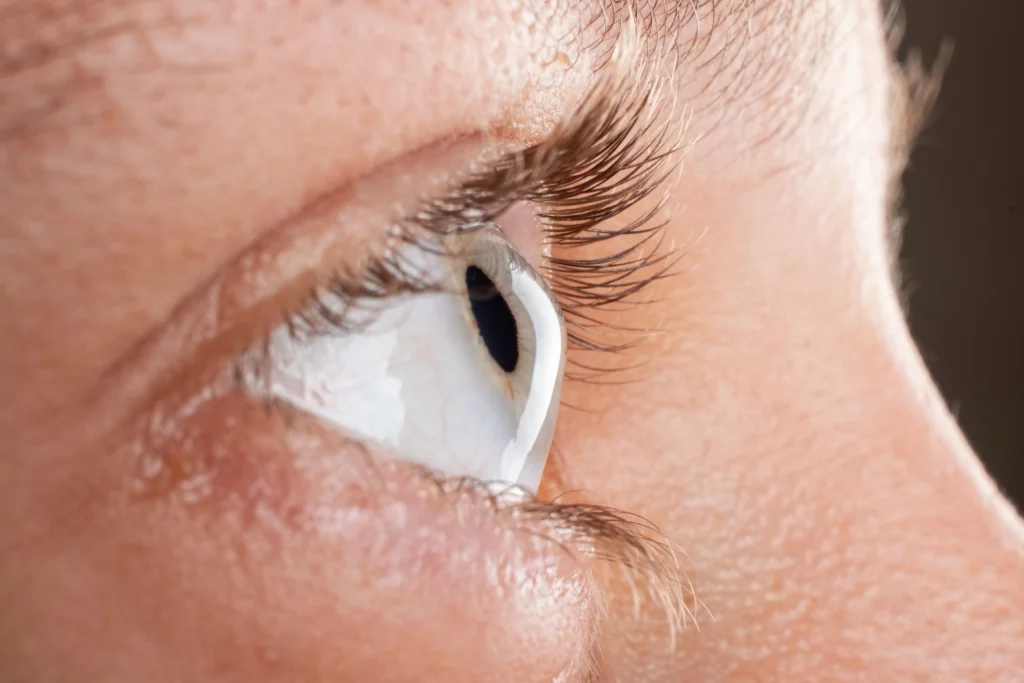The Diagnosis of Keratoconus What to Expect During Your Eye Exam - Keratoconus  - Global Eye Hospital