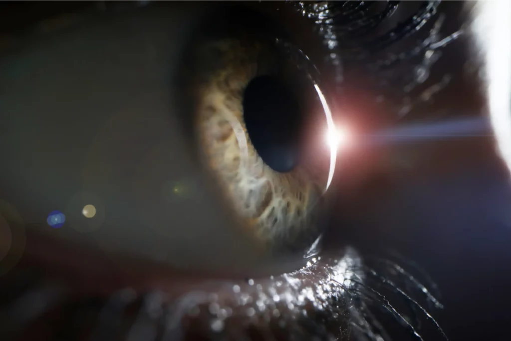 Managing Side Effects of PRK Dry Eyes, Halos, and Glare - Global Eye Hospital