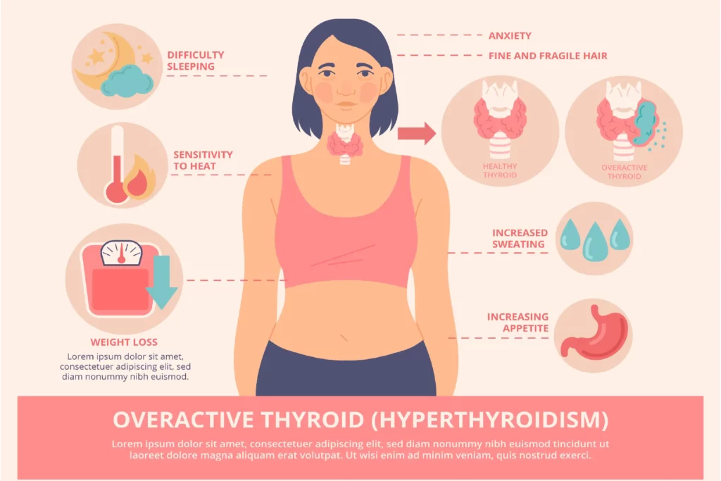 The Thyroid-Eye Connection Understanding the Impact on Eye Health - Global Eye Hospital