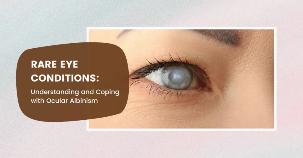 Rare Eye Conditions Understanding and Coping with Ocular Albinism - Global Eye Hospital