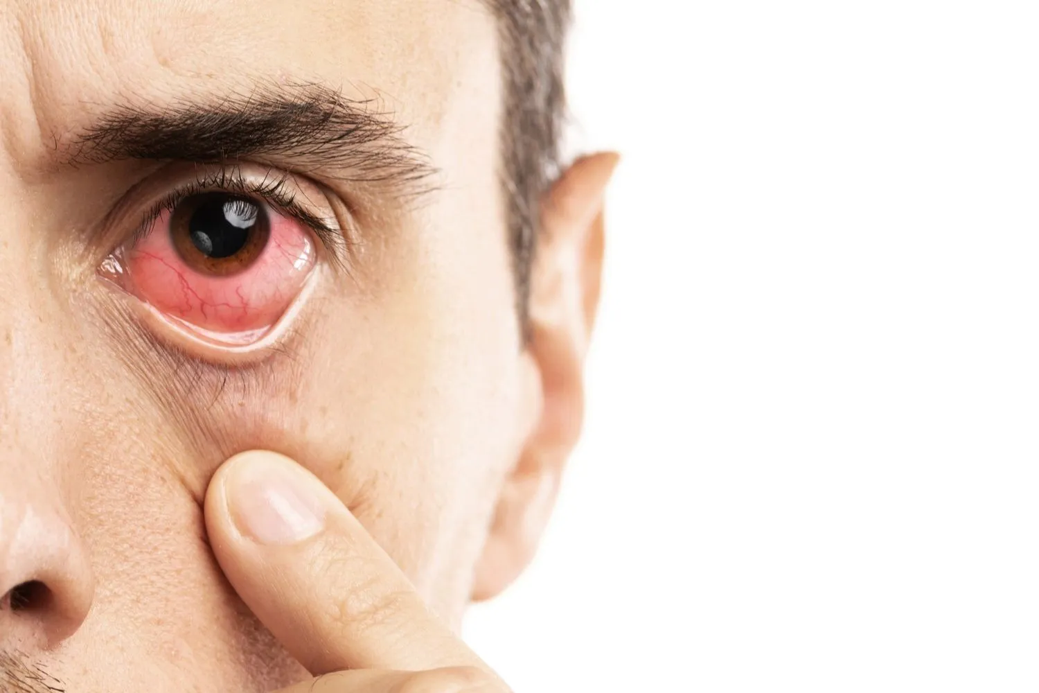 How to Prevent Pink Eye Tips for Keeping Your Eyes Healthy - Global Eye Hospital