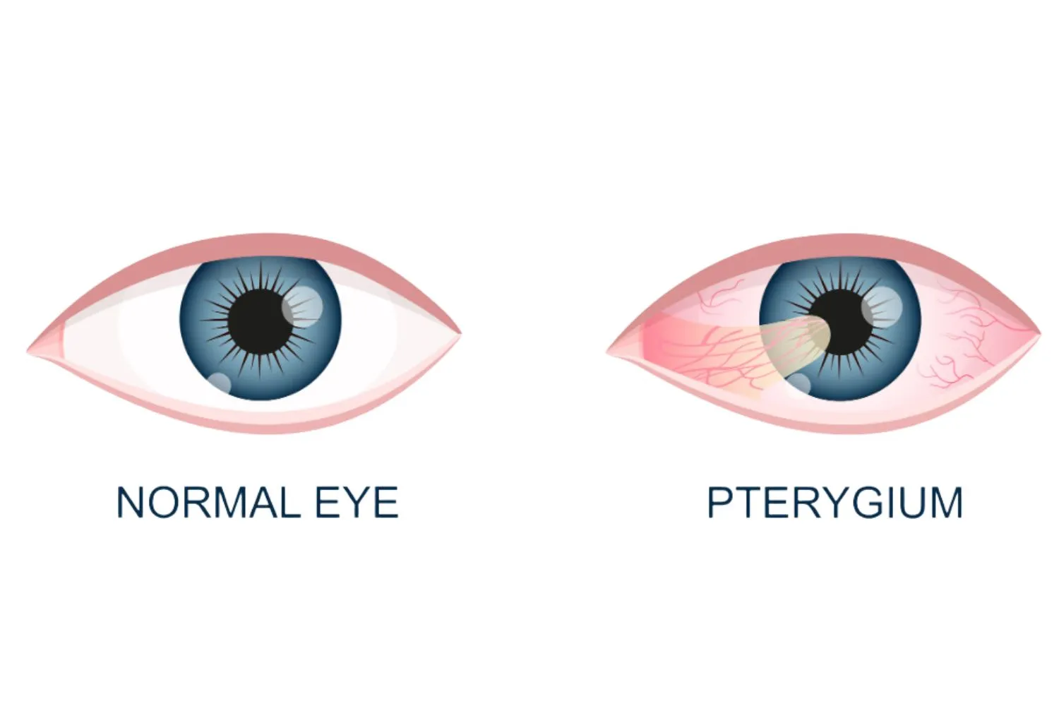 Understanding Pterygium Causes and Treatment - Global Eye Hospital