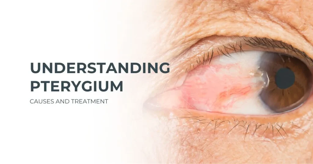 Understanding Pterygium Causes and Treatment - Global Eye Hospital