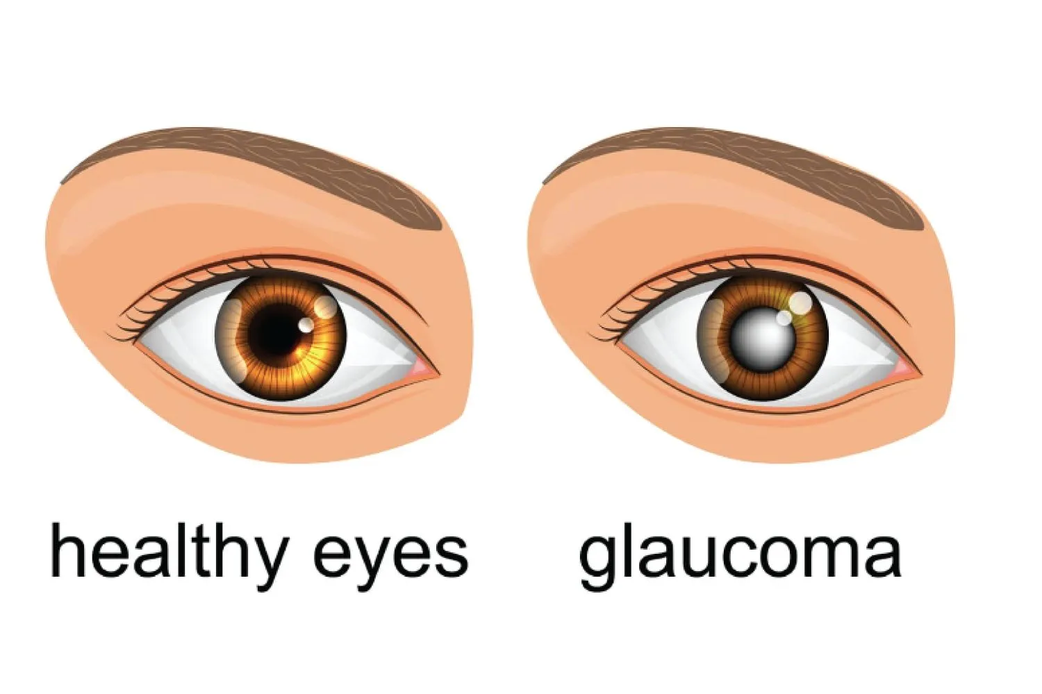 Can technology help detect glaucoma early in younger patients? - Global Eye Hospital