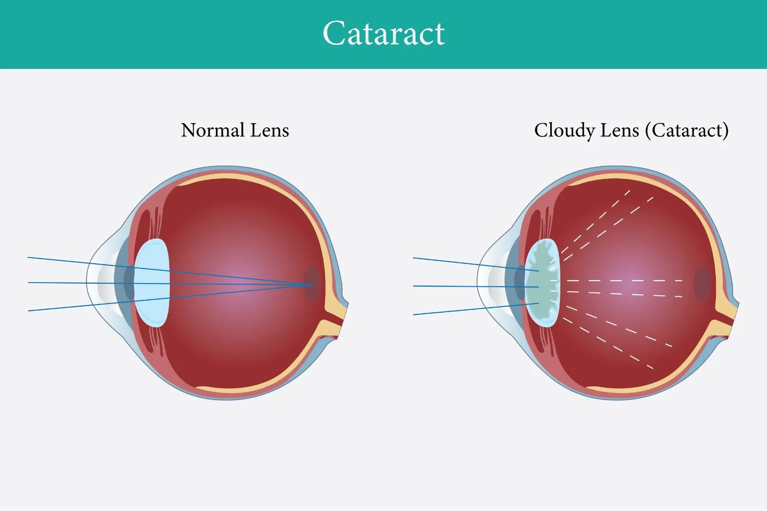 Can Family History Increase the Risk of Developing Eye Conditions? - Global Eye Hospital